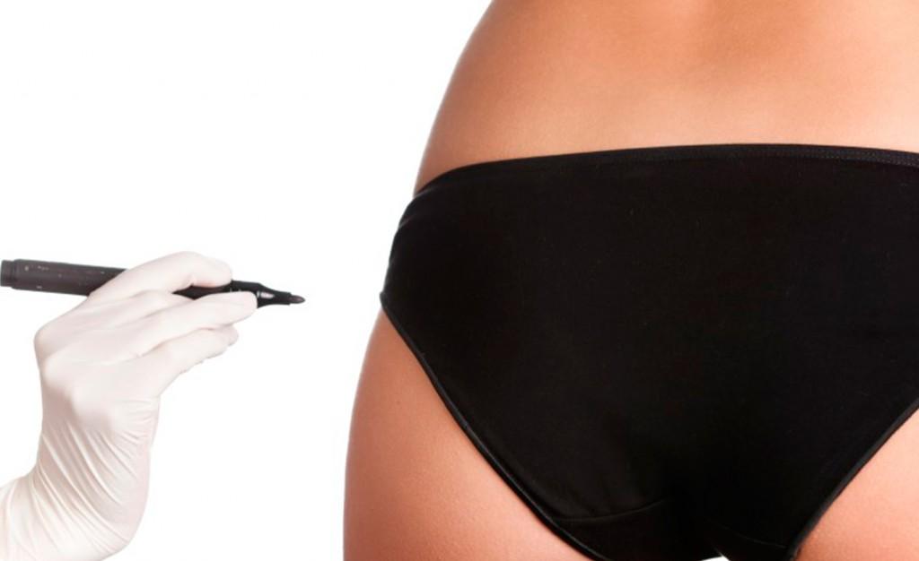 Brazilian Buttock Lift in Cancun | My Medical Vacations