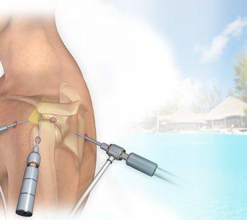 Arthroscopy in Cancun 1