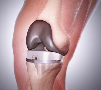 knee replacement in mexico