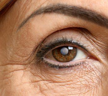 cataract surgery
