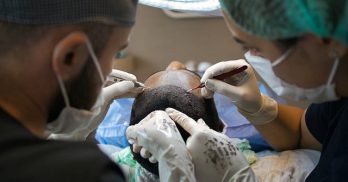 FUE Hair Transplant