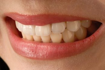 Zirconium Veneers in Cancun