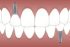 Dental Implants in Mexico