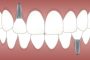 Dental Implants in Mexico