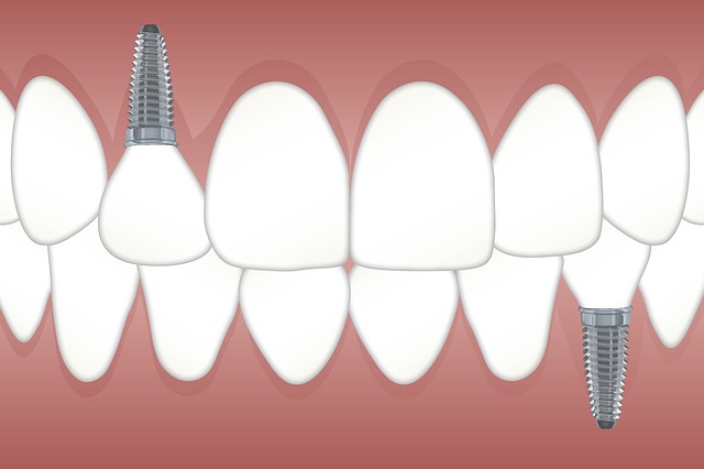 Dental Implants in Mexico