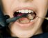 Premium Veneers