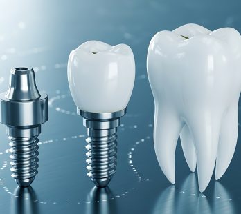 Dental Implants in Cancun