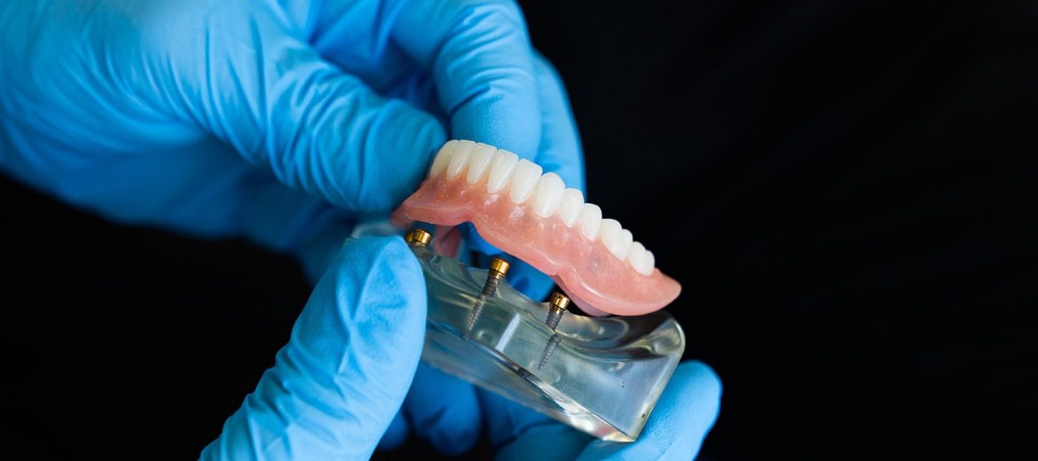 Dental Implants vs. Dentures