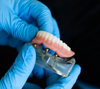 Dental Implants vs. Dentures