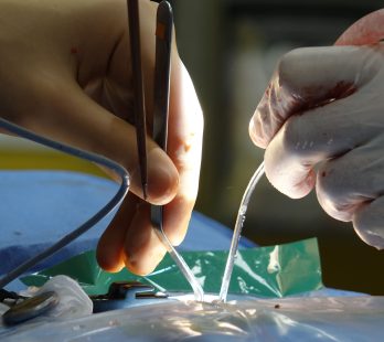 Gallbladder Removal